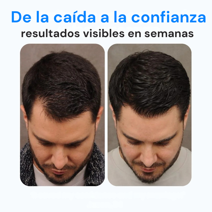 Roll-On Capilar para Frenar la Caída y Estimular el Crecimiento, activando folículos dormidos